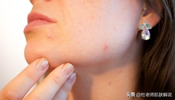 为什么你的痘痘总是反复发作？