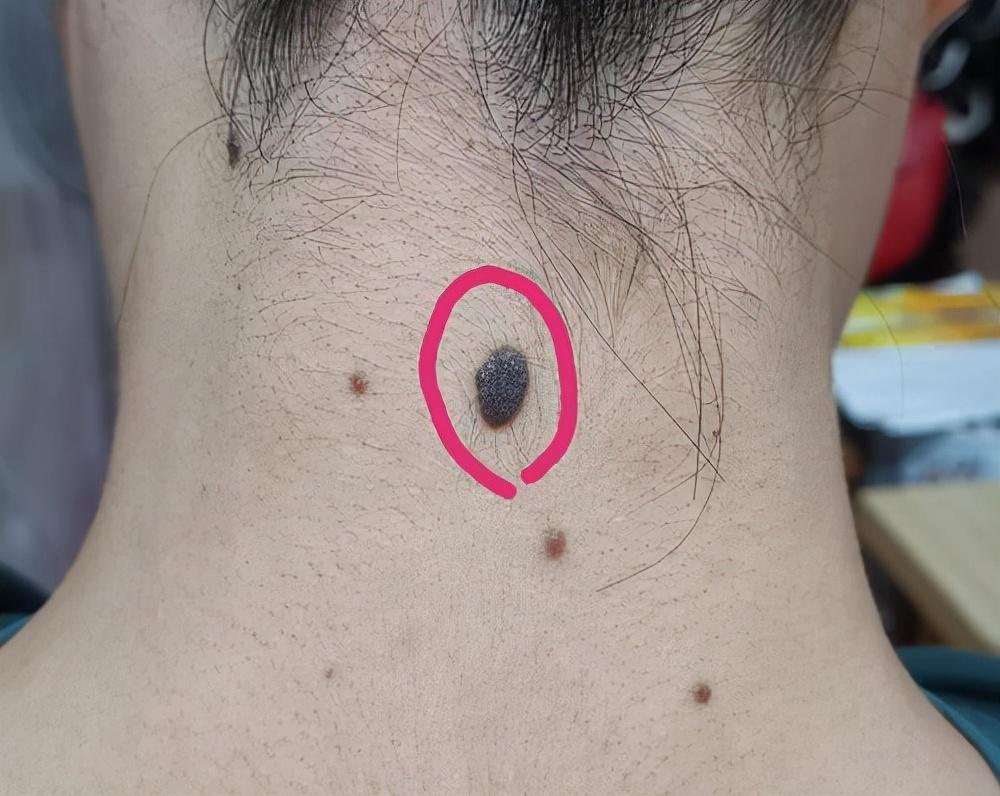 脖子后面的痣真的暗示了人生密码吗？