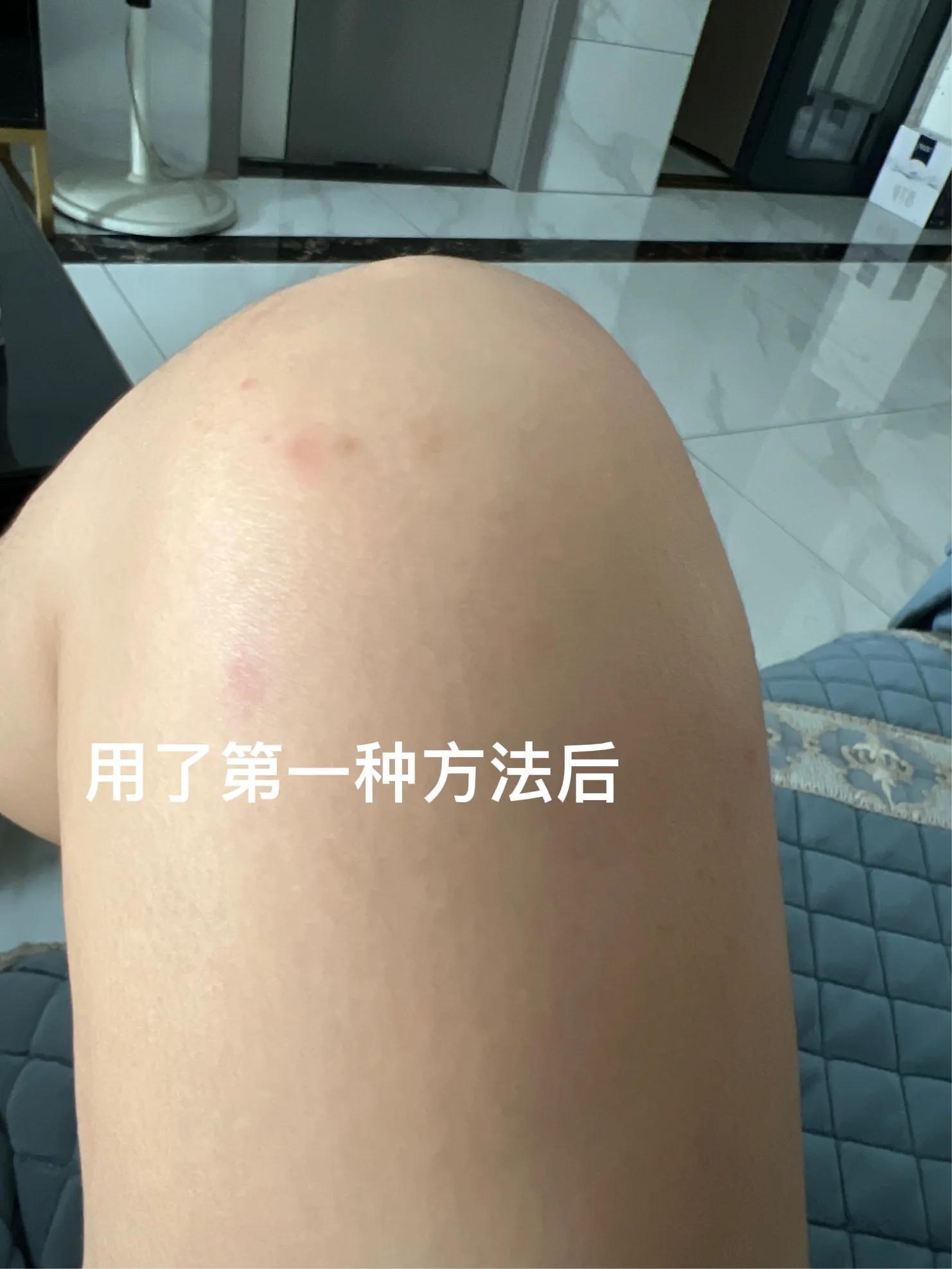 为啥蚊子总爱追着你咬？