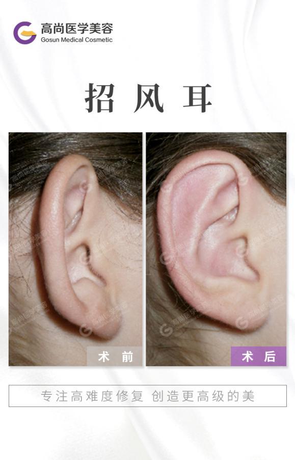 招风耳到底该不该整？