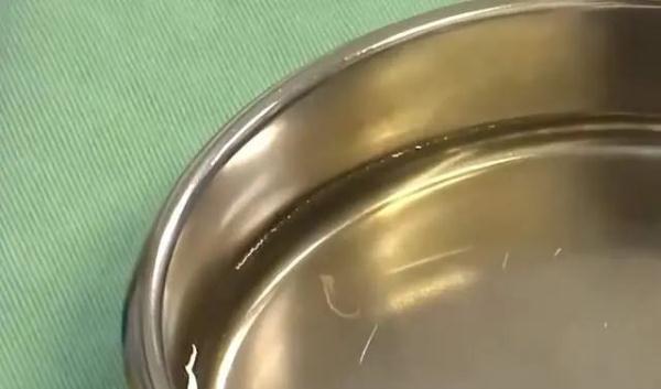 女子因与宠物狗太过亲密，眼中竟捉出两条活虫