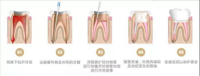 根管治疗后必须做牙冠吗？先看这3个判断点