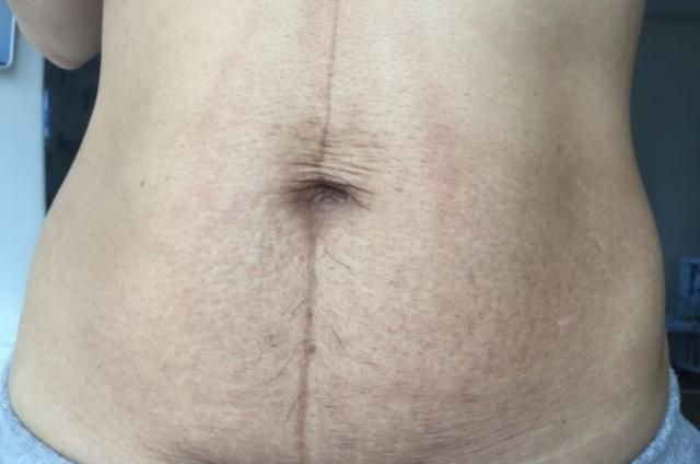 想找妊娠线正常的图片？快看这里，对准妈妈很有用哦