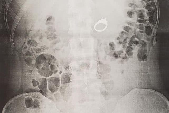 梦见肠子外露又复位？心理学与周公解梦深度解析