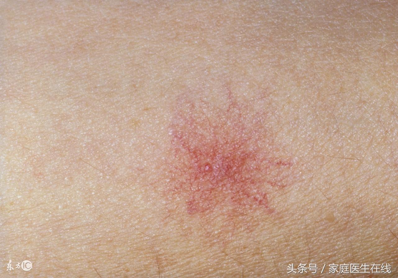 肩膀上有痣真的会影响运势吗？