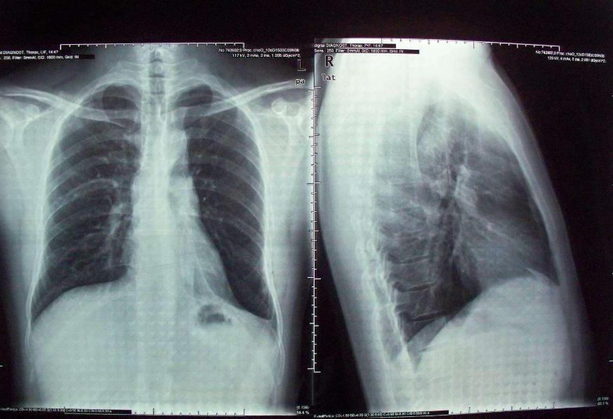 梦见医生检查肺癌预示什么？2025双子座健康转机解析