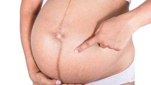 想找妊娠线正常的图片？快看这里，对准妈妈很有用哦