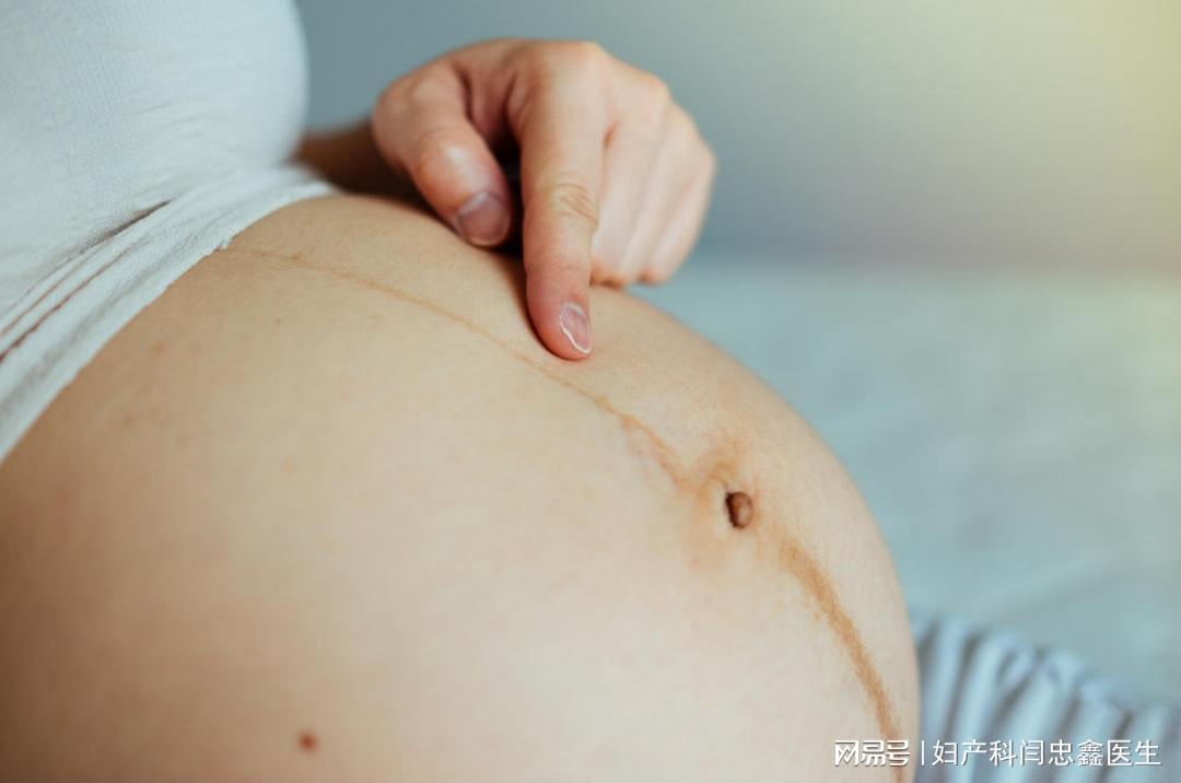 想找妊娠线正常的图片？快看这里，对准妈妈很有用哦