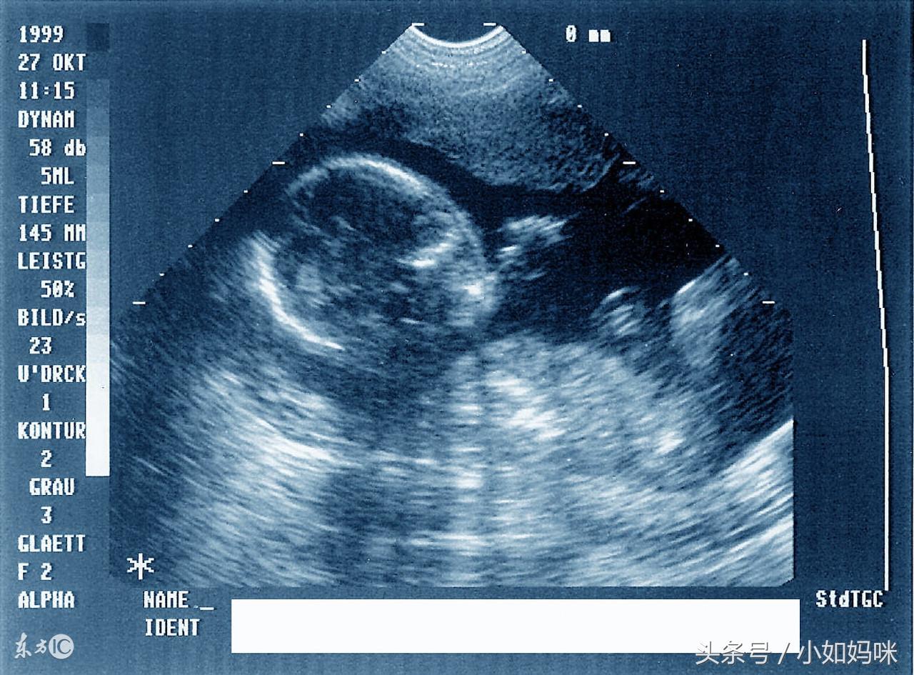 梦见拔腋毛是吉兆吗？2025年天蝎座危机预警与能量净化指南