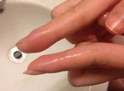 主子脚丫红肿流脓是得了甲沟炎吗？