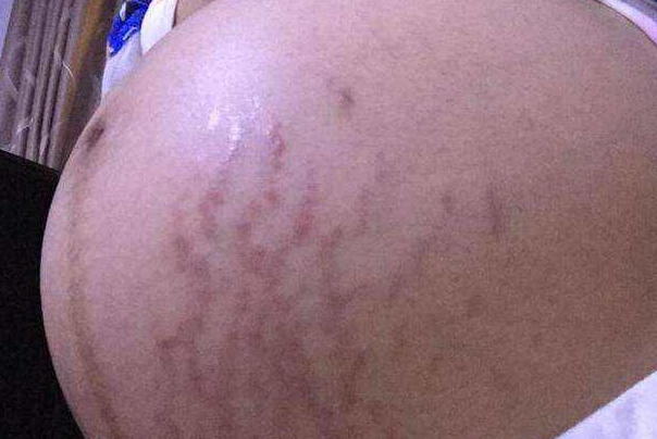 正常的妊娠线图片，别再瞎担心啦，几张图让你看明白