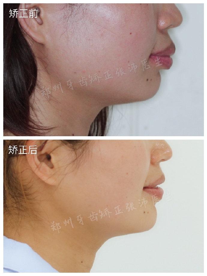 下巴前突真的只能靠手术矫正吗？