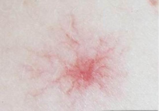 你身上的痣藏着什么人生密码？