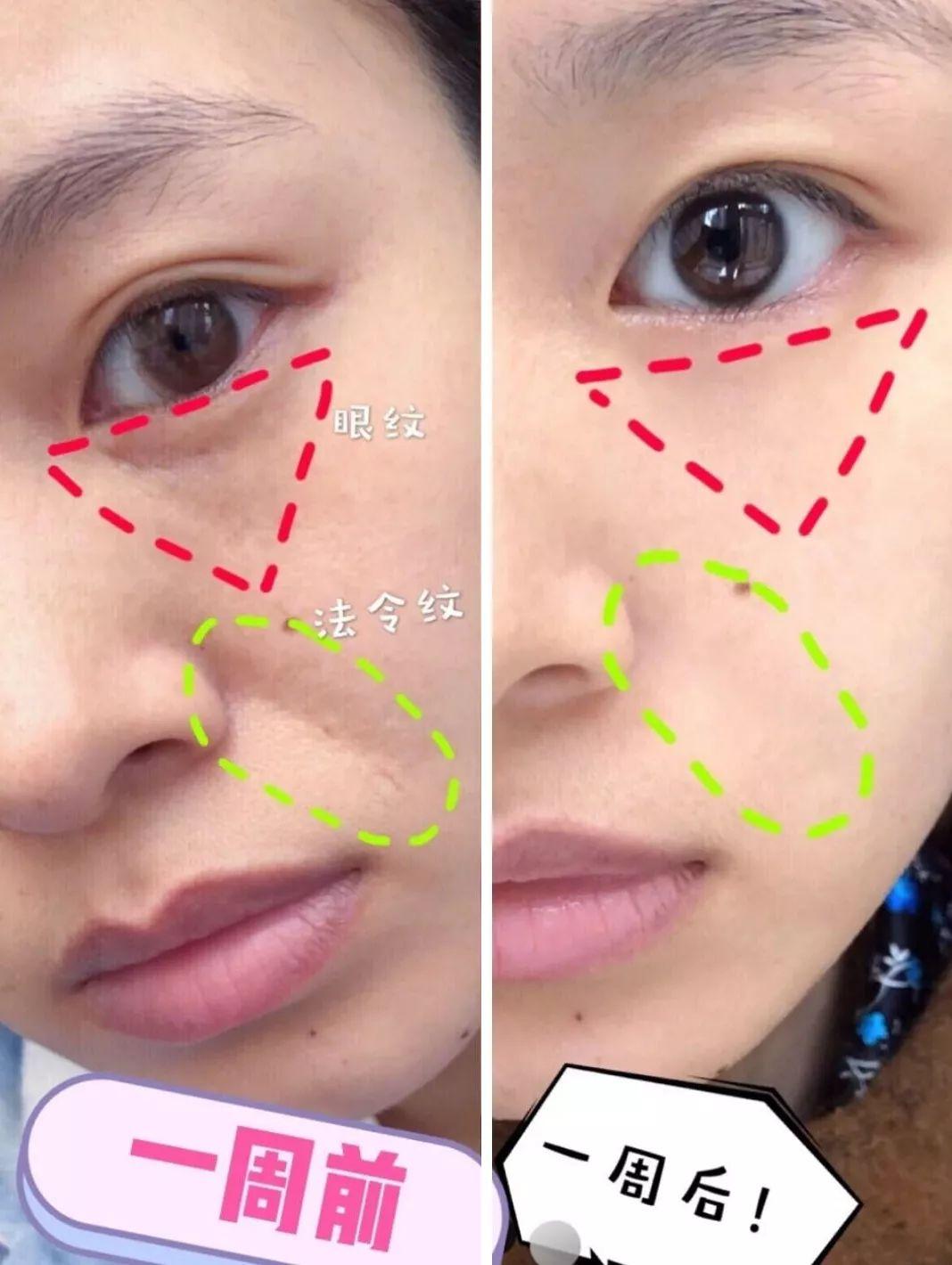 为什么我的法令纹一边深一边浅？