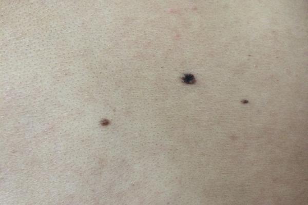 脚底板长痣可能是癌症信号吗？