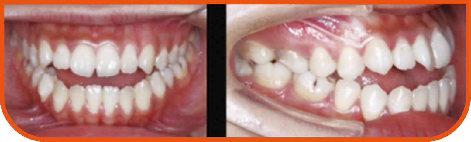 下巴前突真的只能靠手术矫正吗？