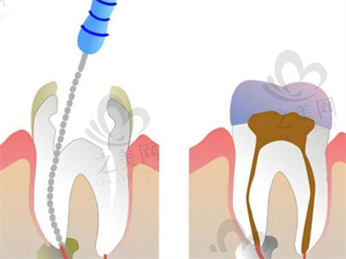 做完根管一定要装牙冠吗？