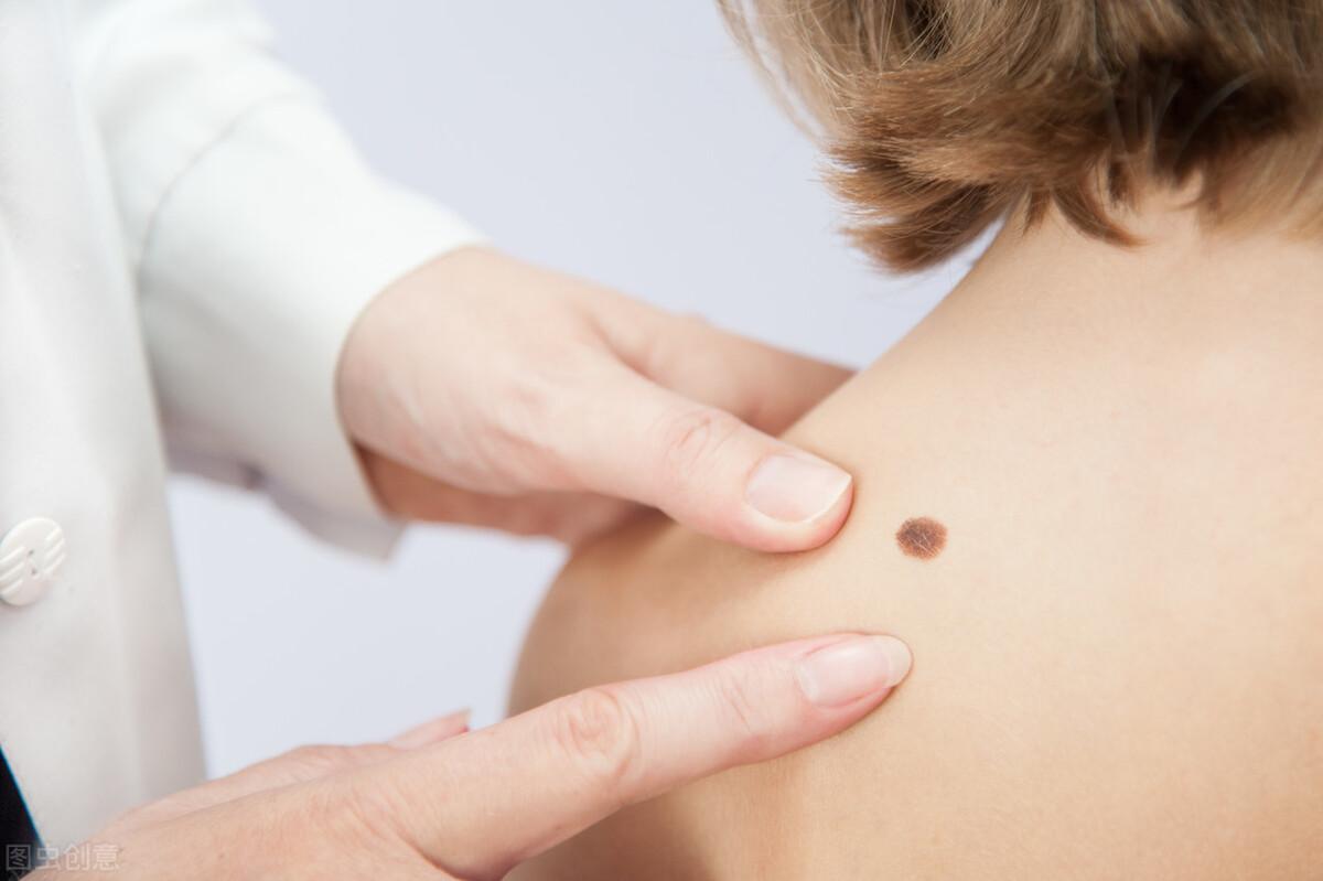 脚底突然长痣是癌症信号吗？