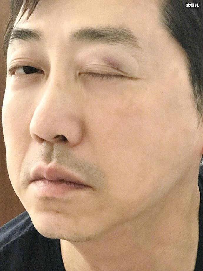 庾澄庆被亲闺女打眼睛