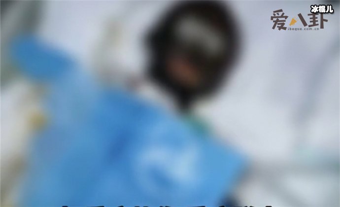 拉姆直播时被前夫烧伤