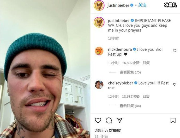 贾斯汀比伯自曝右脸面瘫