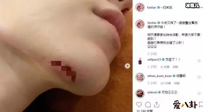 范玮琪下巴缝15针