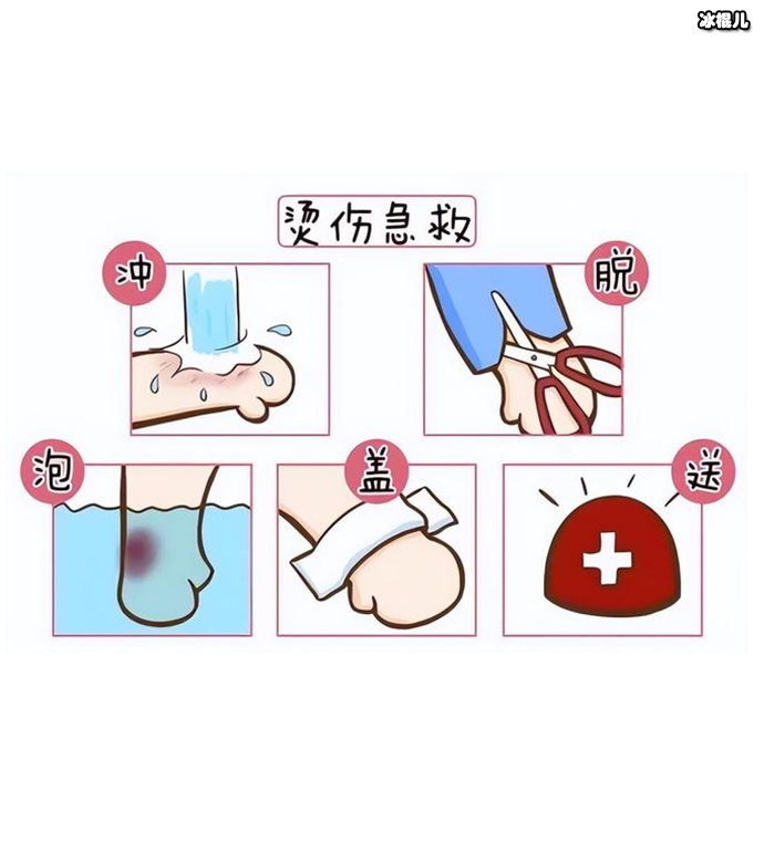 烫伤的急救5步