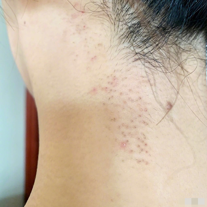 杨紫毛孔发炎照片