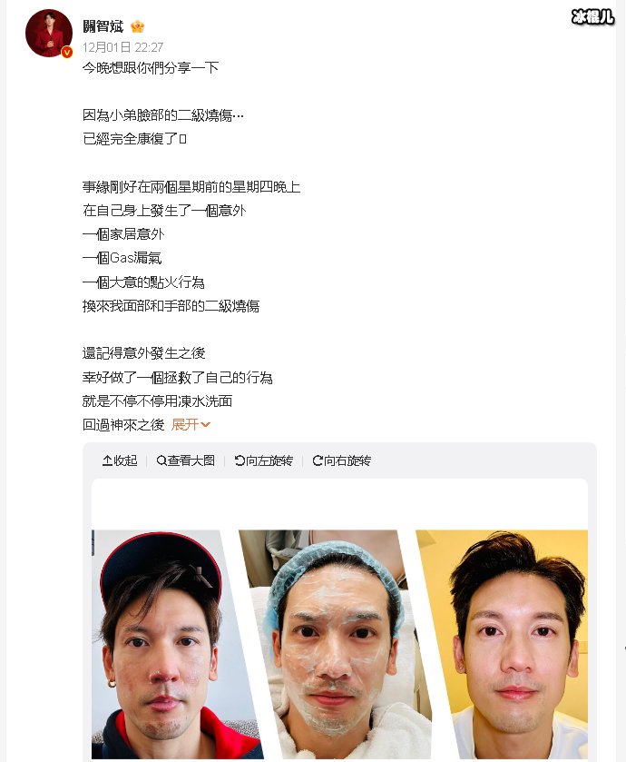 关智斌自曝面部手部二级烧伤