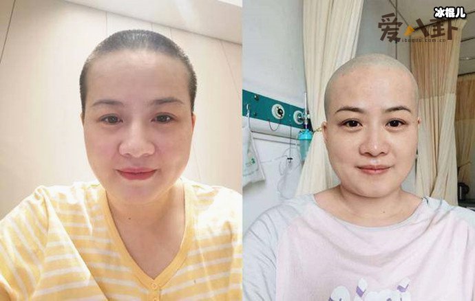 岳云鹏老婆回应生病剃光头