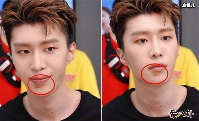 范丞丞受伤近照