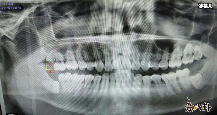 X光下的智齿