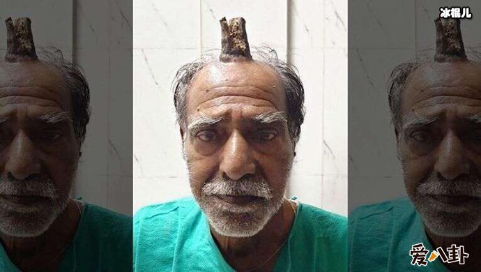 五年后终于切除“牛角”