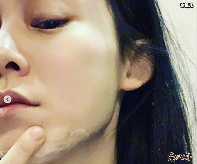 范玮琪下巴缝15针