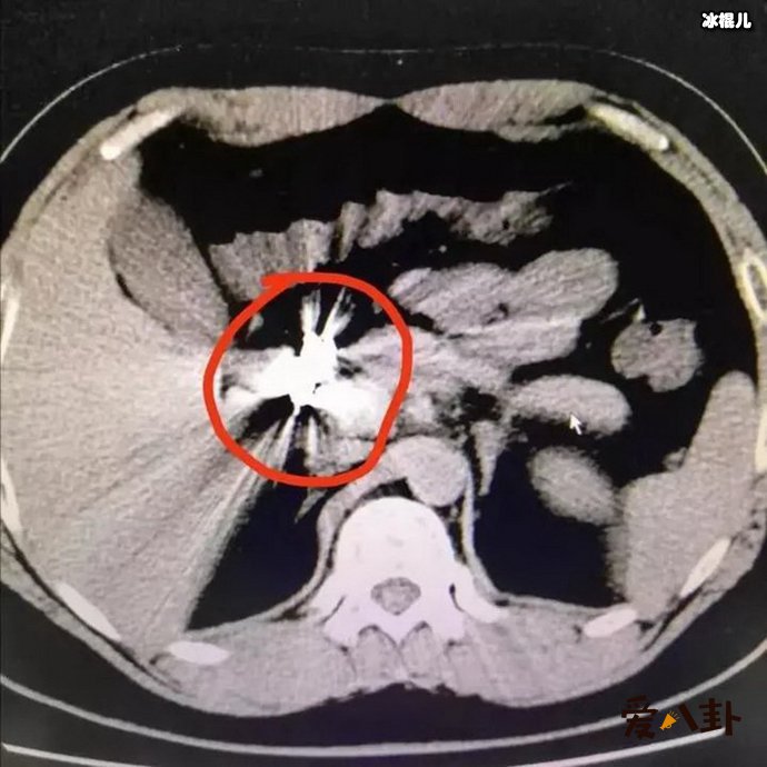 杭州一男生赌气吃一条金项链