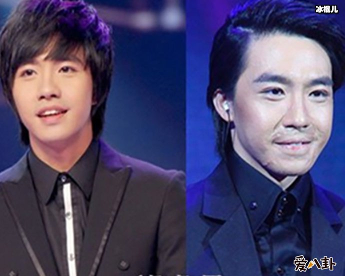 俞灏明烧伤前后对比