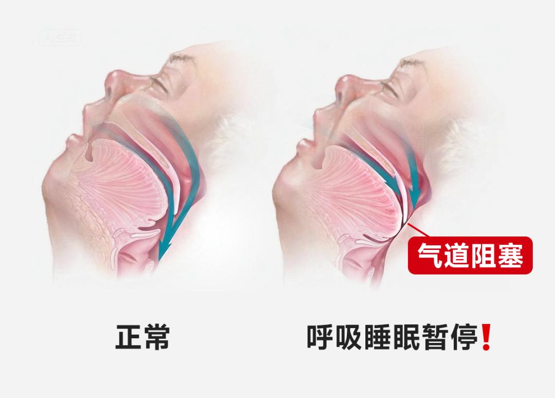 打鼾如何治疗_ggbbm_阻塞性睡眠呼吸暂停综合征